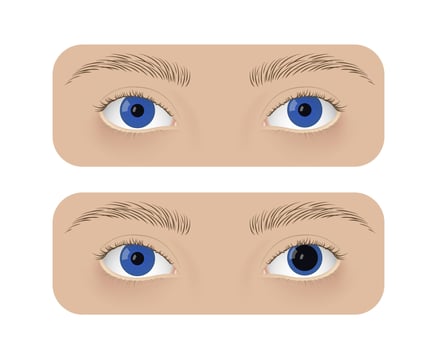 Realistic human normal eyes and with anisocoria. Unequal pupil, anatomy, health. vector