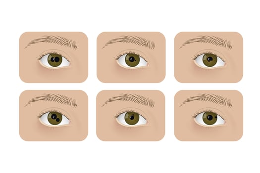 Realistic human eyes with polycoria. Human sickness, anatomy, health. vector