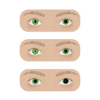 Realistic human eyes with anisocoria. Unequal pupil, anatomy, health. vector