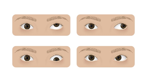 Realistic human eyes with strabismus. Crossed eyes, hypertropia, exotropia, hypotropia and esotropia vector