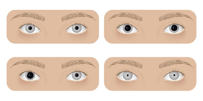 Realistic human normal eyes and with mydriasis, anisocoria, miosis. Human disease, anatomy, health. vector