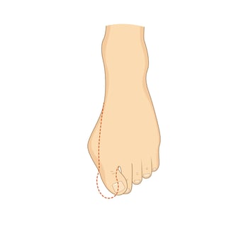 Hallux valgus surgery correction. Medical orthopedics vector