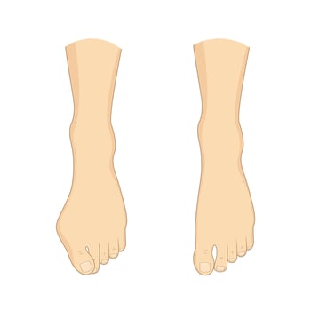 Hallux valgus, mild bunion correction. Medical surgery orthopedics vector