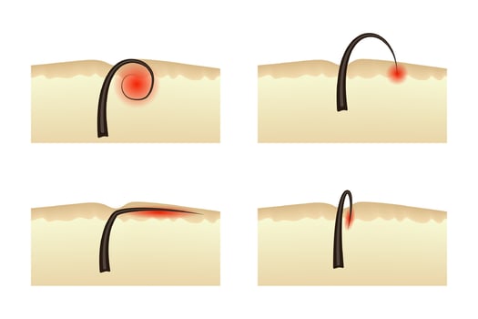 Ingrown hairs after epilation. Inflammation of the skin dermatology. vector