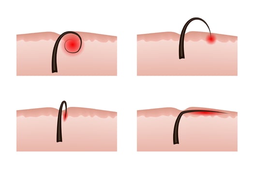Ingrown hairs after depilation. Inflammation of the skin and epidermis. vector