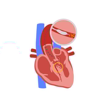 Alcohol Septal Ablation, Cardiovascular Disease Illustration Icon vector
