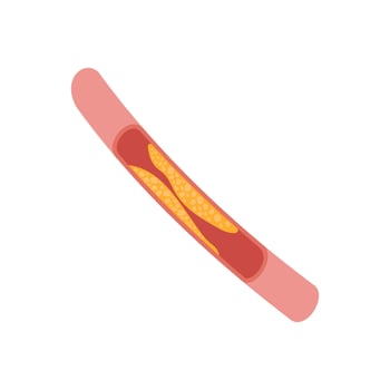 Arterial Fat, Cardiovascular Disease Illustration Icon vector