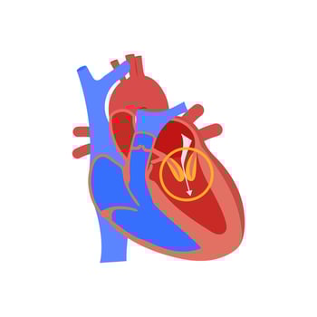 Mitral Stenosis, Cardiovascular Disease Illustration Icon vector