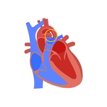 Patent Ductus Arteriosus, Cardiovascular Disease Illustration Icon vector