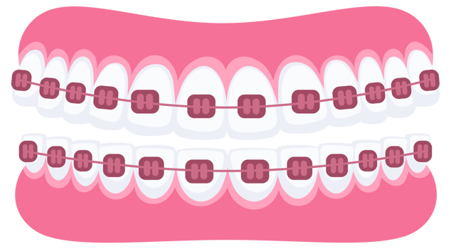 Teeth with braces. Orthodontic treatment. Tooth braces. Teeth with metal brackets png