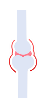 Joint pain causing inflammation and discomfort in bones png