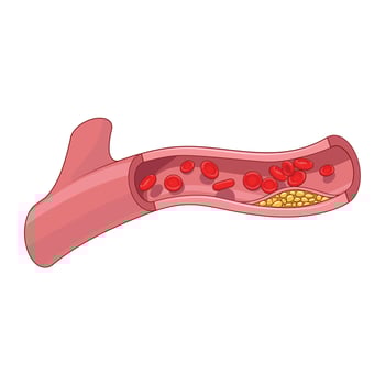 Blood vessel and cholesterol plaque medical science educational illustration vector