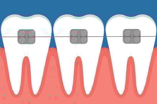 illustration of teeth with braces. vector