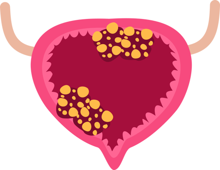 Urinary bladder cancer png