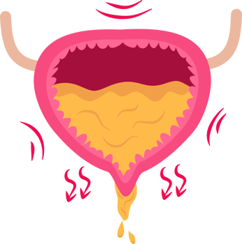 Overactive urinary bladder png