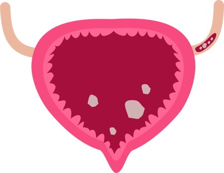 Urinary bladder stones png