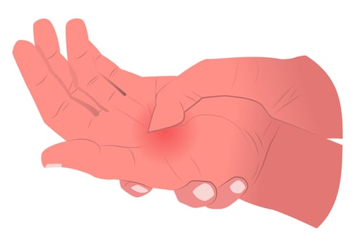 illustration of a sore palm, suitable for medical professionals, or designers who create content related to health, physical therapy, or injury prevention vector