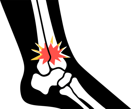 Illustration of a leg bone fracture injury png