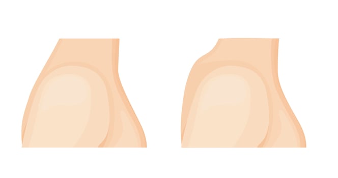 Cervical osteochondrosis and healthy neck. Medical care, Treatment hump on the neck. Orthopedics therapy vector