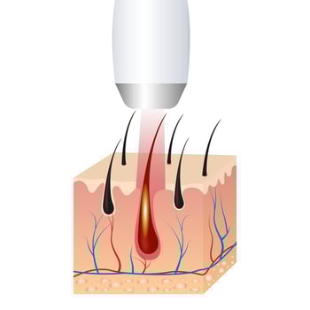 Illustration of hair removal with laser and IPL. Skin structure of hair vector