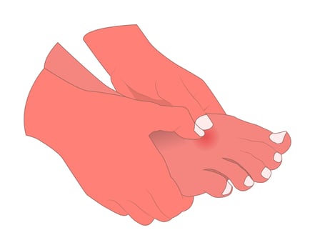 illustration of foot pain, Ideal for use in health and fitness content, medical brochures, orthopedic advertisements, physiotherapy guides, or educational materials vector