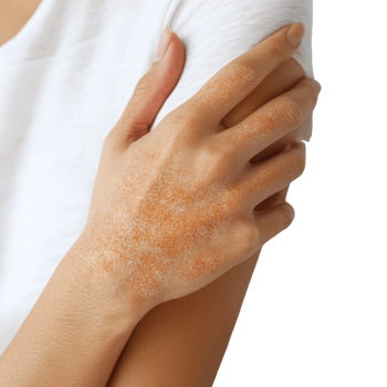 A close-up of a hand with skin irritation, possibly a rash, against a neutral background, highlighting the texture and condition of the skin. png
