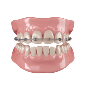 teeth braces on a transparent background png