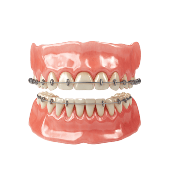 teeth braces on a transparent background png