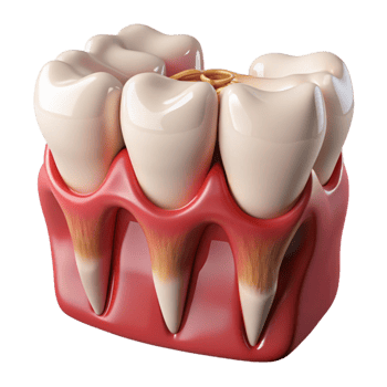 3D Model Gum Recession Teeth Illustration png
