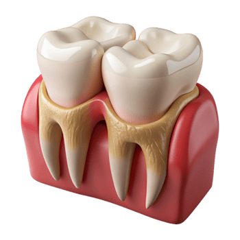 Gum Recession Tooth Root Exposed png