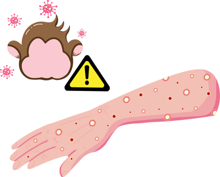 Healthcare Information About Monkeypox Infection png