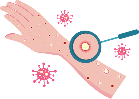 Monkeypox Alert with Infected Skin Condition png
