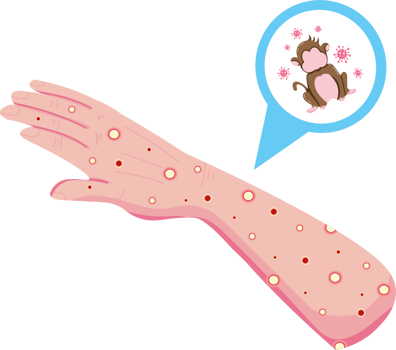 Monkeypox Outbreak Prevention and Hygiene Tips png