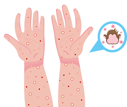 Health Warning About Monkeypox Disease png