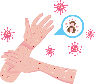 Monkeypox Awareness Design with Skin Lesions png