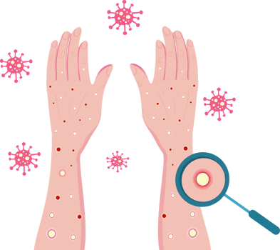 Medical Concept of Monkeypox Infection and Transmission png