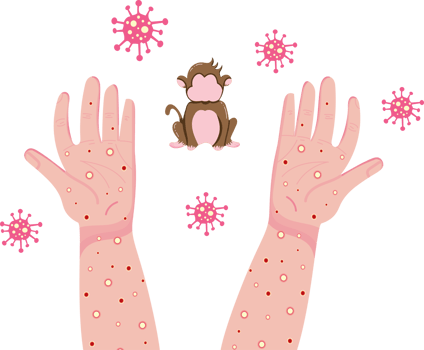 Monkeypox Virus Symptoms and Skin Rash Illustration png