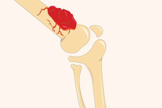 An illustration of osteosarcoma in a knee joint, showing bone damage and tumor growth. eps 10 vector