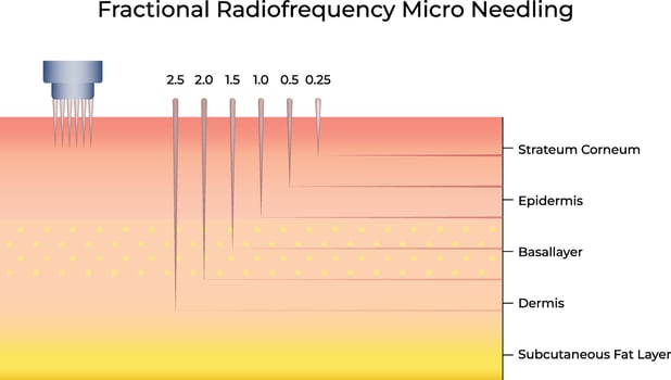 Fractional Radiofrequency Micro Needing Science Design Illustration Diagram vector