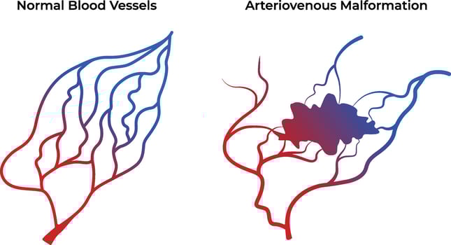 Normal Blood Vessels Arteriovenous Malformation Science Design Illustration Diagram vector