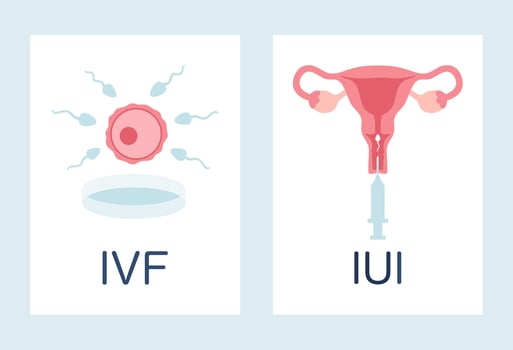 In vitro fertilization IVF and intrauterine insemination IUI infographic posters set. Egg, sperm, uterus and syringe illustration in cartoon flat style vector