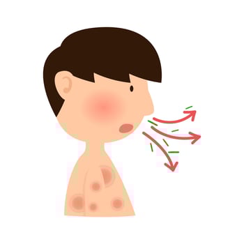 transmission leprosy disease. mycobacterium leprae infection concept vector