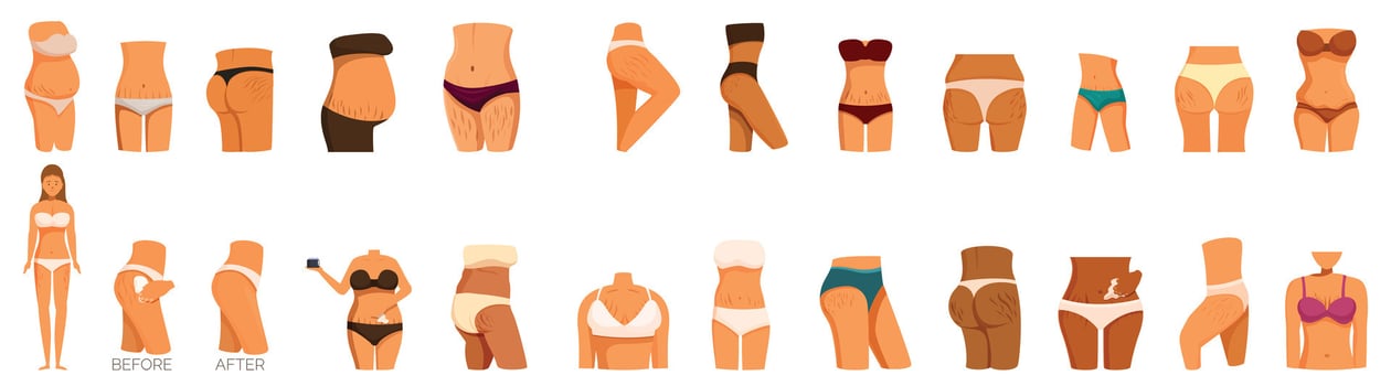 Stretch marks icons set. Woman body before and after weight loss showing cellulite and stretch marks vector