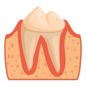 Periodontitis affecting tooth enamel and gum health illustration vector