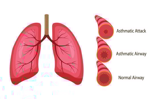 Stages of an asthma attack. medical illustration. eps 10 vector