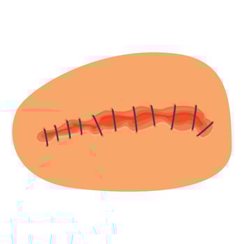 Surgical wound with stitches healing on skin surface vector