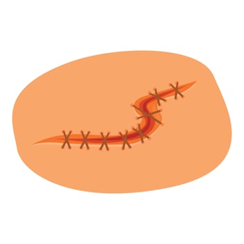 Surgical suture closing a wound on skin surface, first aid concept vector