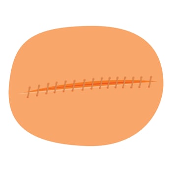 Surgical sutures closing skin wound after medical procedure vector