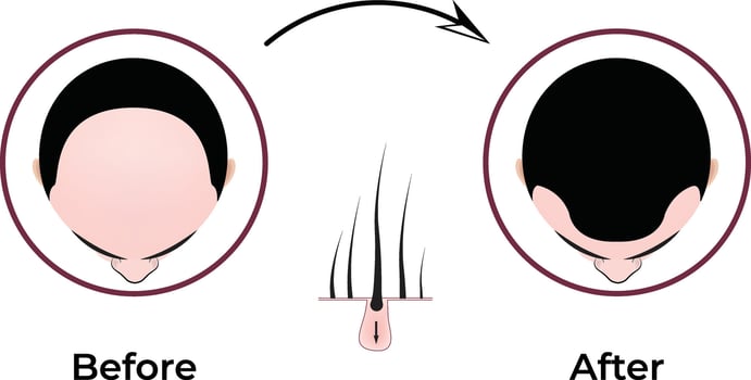 Hair Regrowth Treatment Design vector