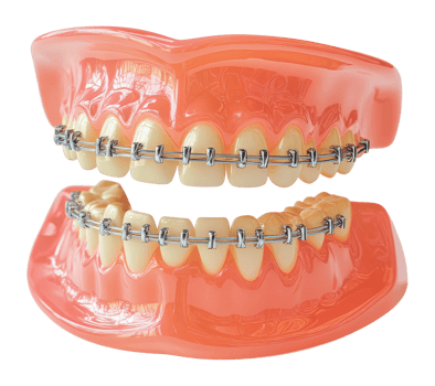 Dental model showcasing braces and teeth alignment png